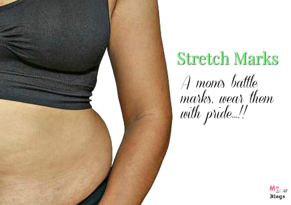 Stretch marks