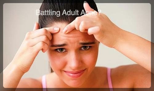 Adult Acne – NOT  A MYTH !!