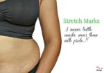 Stretch Marks: A Mom’s Battle Scars